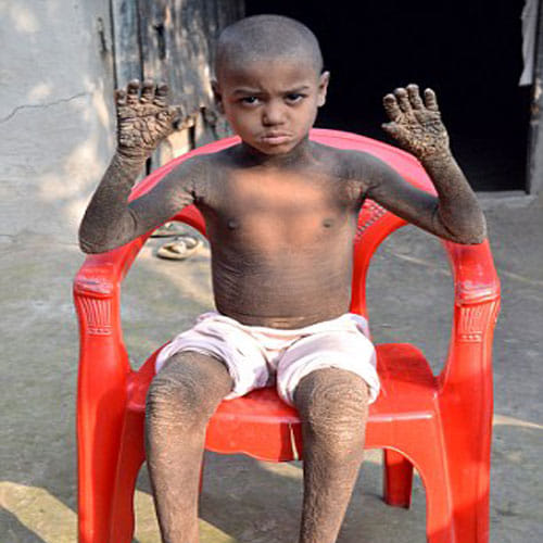 Kid In Bangladesh Is Slowly Turning Into Stone Due To An Incurable Diesease
