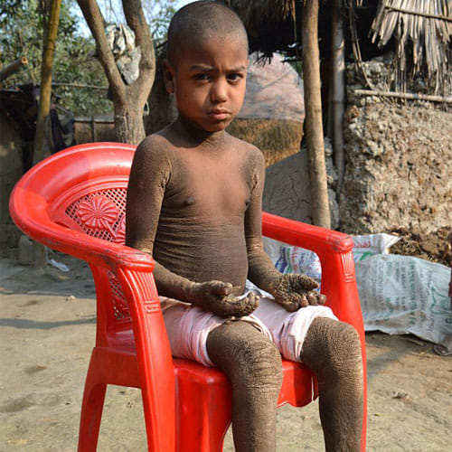Kid In Bangladesh Is Slowly Turning Into Stone Due To An Incurable Diesease