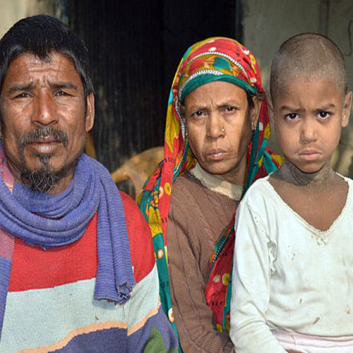 Kid In Bangladesh Is Slowly Turning Into Stone Due To An Incurable Diesease