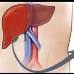 liver transplant