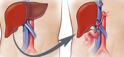 Delhi : First auto liver transplant in North India, saved the life of a foreign patient