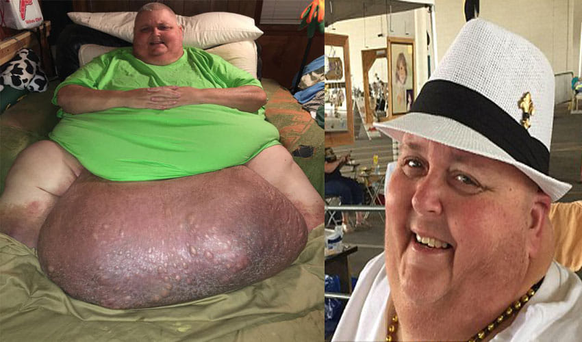 Man In America Got Operated After Found 64 Kg Tumour