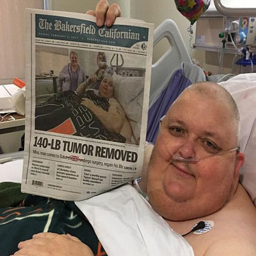 Man In America Got Operated After Found 64 Kg Tumour