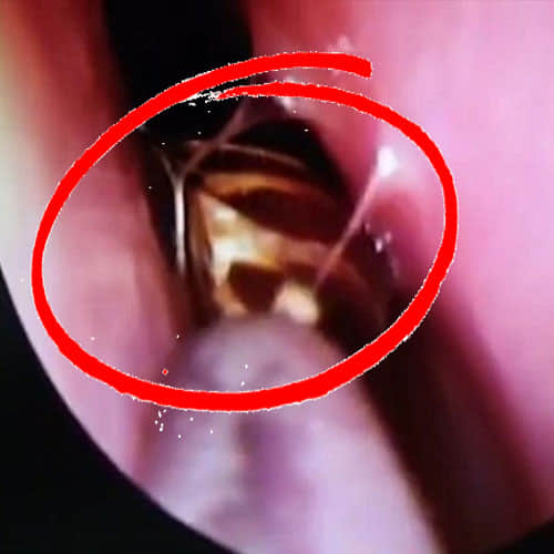 Alive Cockroach Found In Woman's Head In Tamil Nadu
