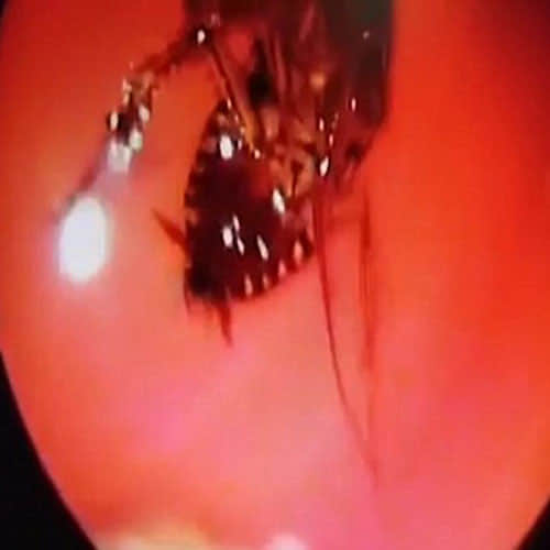Alive Cockroach Found In Woman's Head In Tamil Nadu