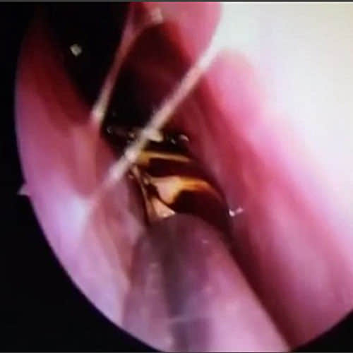 Alive Cockroach Found In Woman's Head In Tamil Nadu