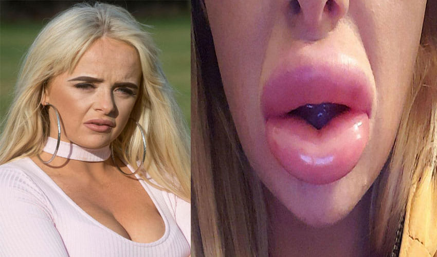 Woman Surgery For Fuller Lips Goes Horribly Wrong, Lips Looks Like Sausages