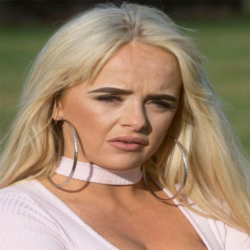 Woman Surgery For Fuller Lips Goes Horribly Wrong, Lips Looks Like Sausages
