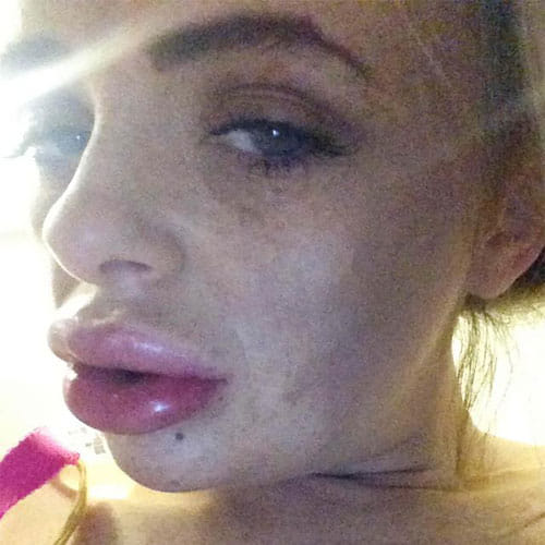 Woman Surgery For Fuller Lips Goes Horribly Wrong, Lips Looks Like Sausages