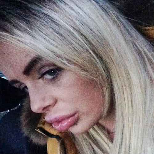Woman Surgery For Fuller Lips Goes Horribly Wrong, Lips Looks Like Sausages