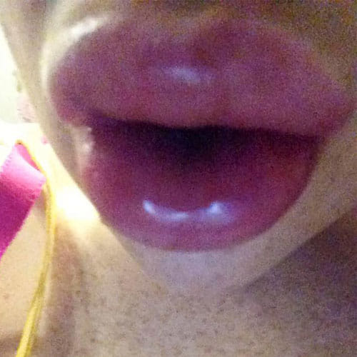 Woman Surgery For Fuller Lips Goes Horribly Wrong, Lips Looks Like Sausages