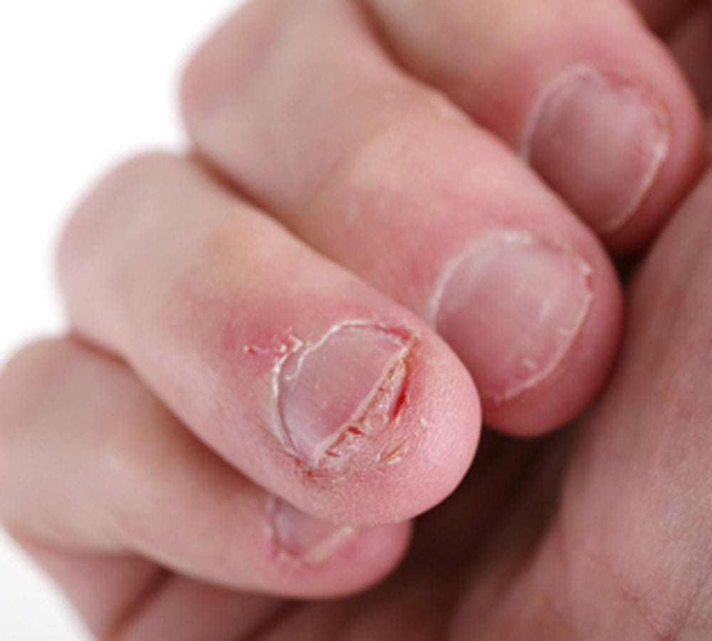 nails biting can be harmful for health 