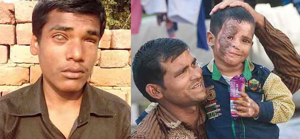 this kid has to sleep with one eye open': Terrified and 'forgotten' male survivors of acid attacks