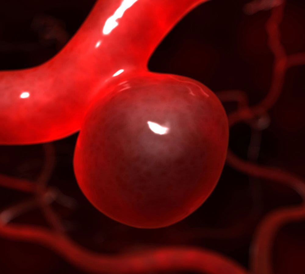 anger can lead to aneurysm