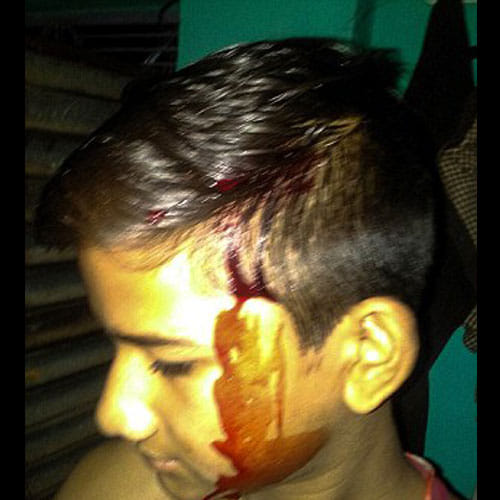 Boy In Madhya Pradesh Bleeds From Body, Doctors Have No Idea About The Case