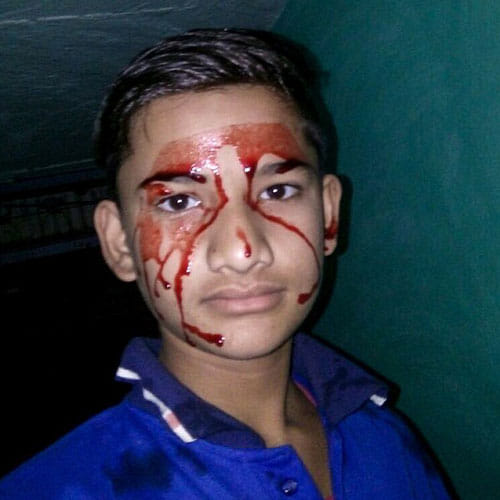 Boy In Madhya Pradesh Bleeds From Body, Doctors Have No Idea About The Case