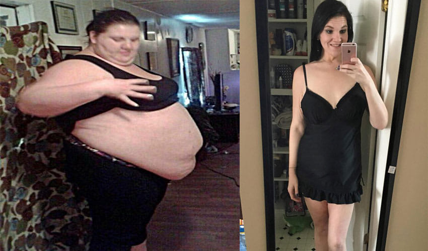 Woman In America Sheds 107 Kg Weight With The Help Of Surgeries