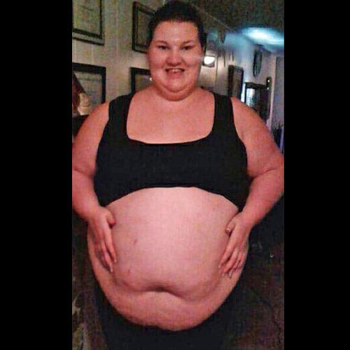 Woman In America Sheds 107 Kg Weight With The Help Of Surgeries