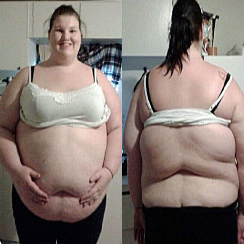 Woman In America Sheds 107 Kg Weight With The Help Of Surgeries