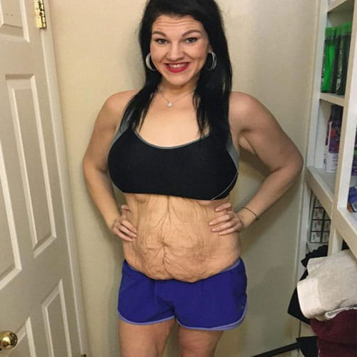 Woman In America Sheds 107 Kg Weight With The Help Of Surgeries