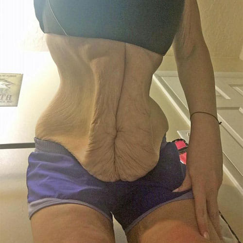 Woman In America Sheds 107 Kg Weight With The Help Of Surgeries