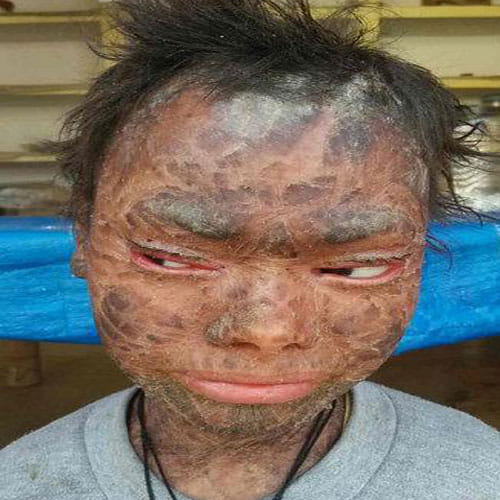 Girl's Skin Peels Off In Every Six Weeks Due To A Rare Skin Disorder