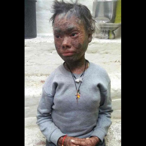 Girl's Skin Peels Off In Every Six Weeks Due To A Rare Skin Disorder