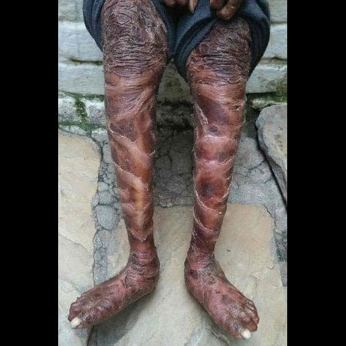 Girl's Skin Peels Off In Every Six Weeks Due To A Rare Skin Disorder