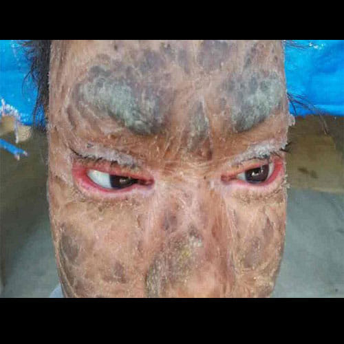 Girl's Skin Peels Off In Every Six Weeks Due To A Rare Skin Disorder