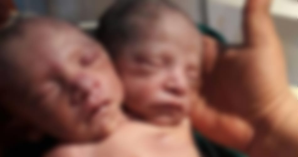 Woman In Yamunanagar Gave Birth To A Child with Two Mouth, Photo Viral on Social Media
