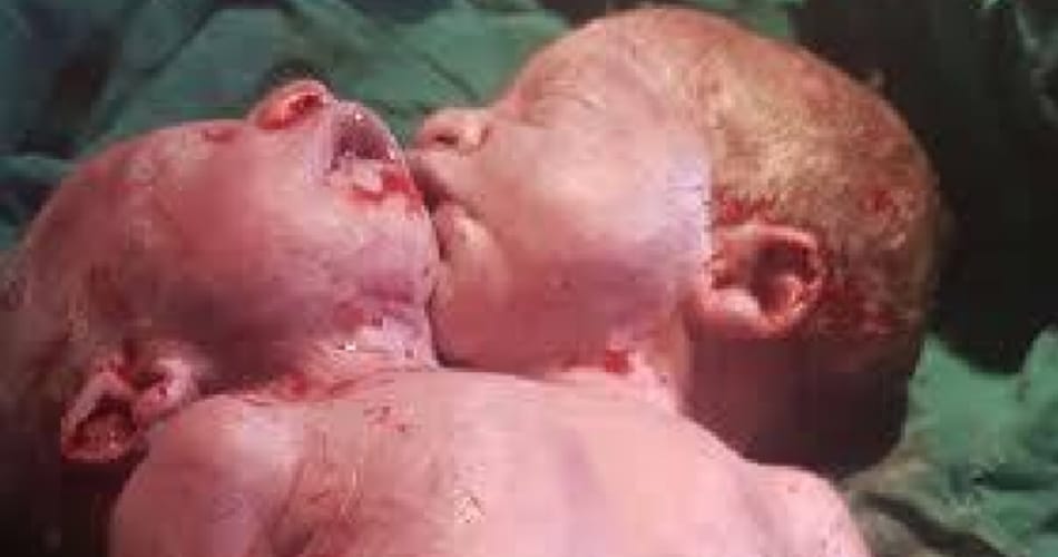 Woman In Yamunanagar Gave Birth To A Child with Two Mouth, Photo Viral on Social Media