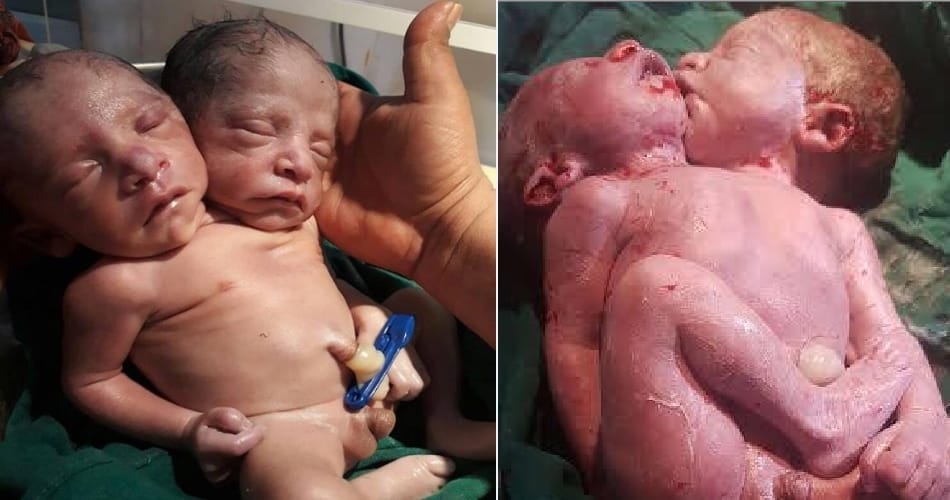Woman In Yamunanagar Gave Birth To A Child with Two Mouth, Photo Viral on Social Media