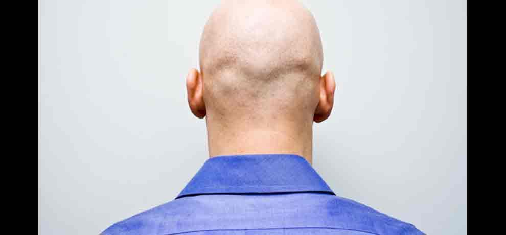 27 year old engineer committed suicide due to hair fall in ghziabad 