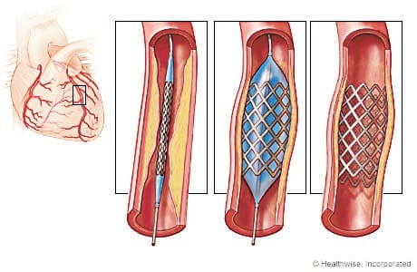 Hospitals were missing from modern stent