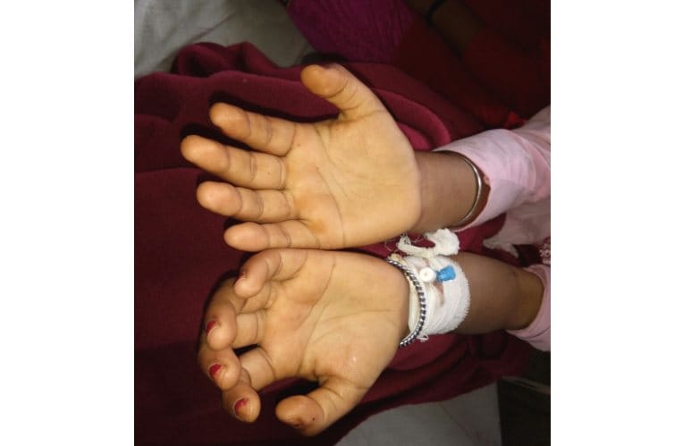 Mysterious Snake Bite Manisha 34 Times.