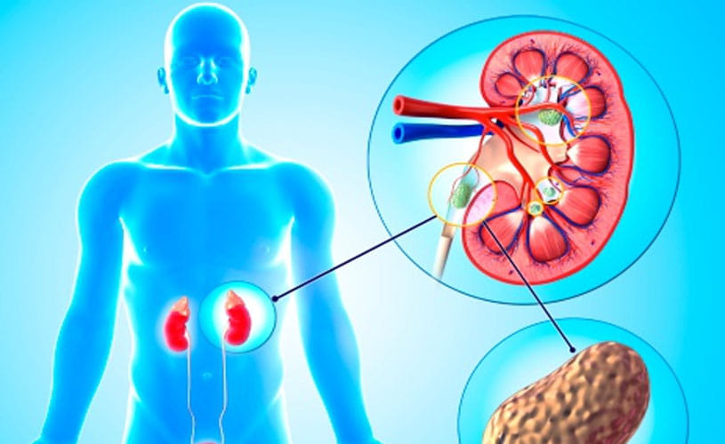 These Superfoods Remove Kidney Stone 