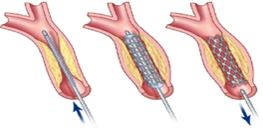 No additional charge on stents 