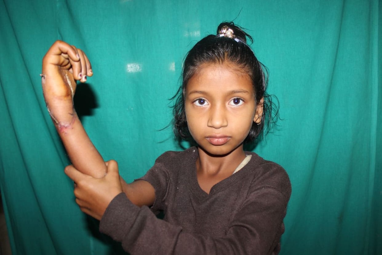 kgmu plastic surgery team fixed palm with wrist