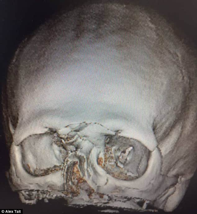  Yorkshire club cricketer Alex Tait suffered horrific facial injuries after being struck 