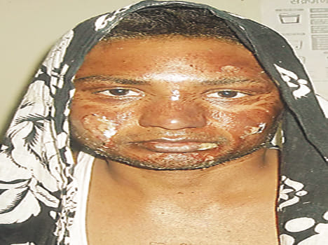 CHC scorching young man to save 18 people