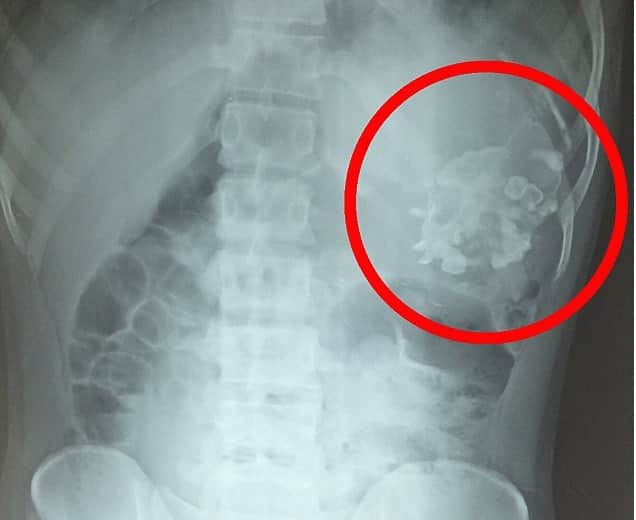 Teen Was Horrified To Find Parasite Twin With Teeth And Hair Inside His Stomach.