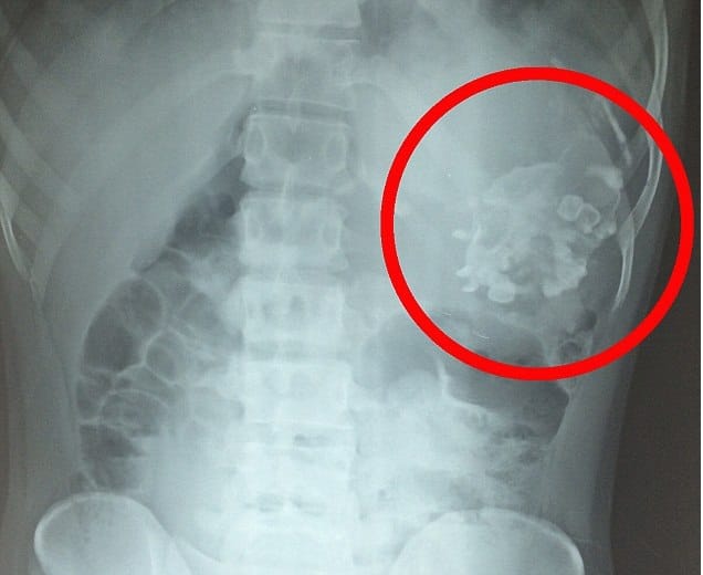 Teen Was Horrified To Find Parasite Twin With Teeth And Hair Inside His Stomach.