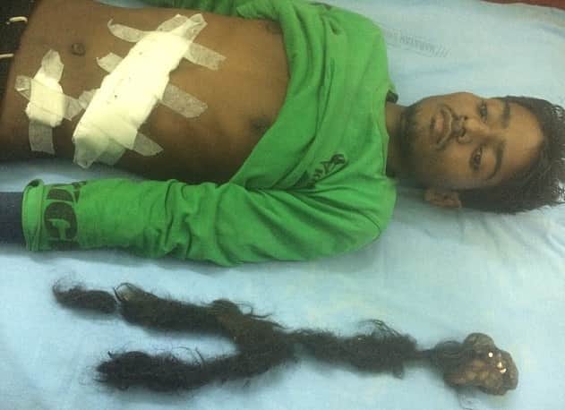 Teen Was Horrified To Find Parasite Twin With Teeth And Hair Inside His Stomach.