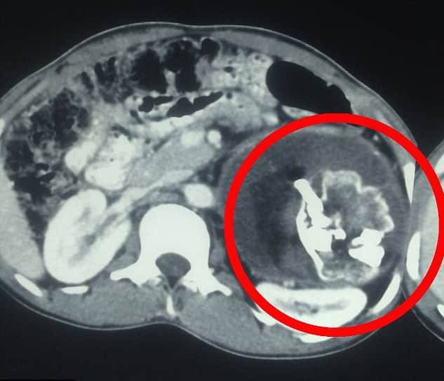 Teen Was Horrified To Find Parasite Twin With Teeth And Hair Inside His Stomach.