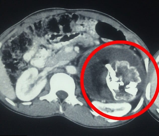 Teen Was Horrified To Find Parasite Twin With Teeth And Hair Inside His Stomach.
