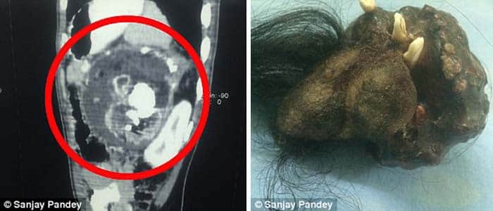 Teen Was Horrified To Find Parasite Twin With Teeth And Hair Inside His Stomach.