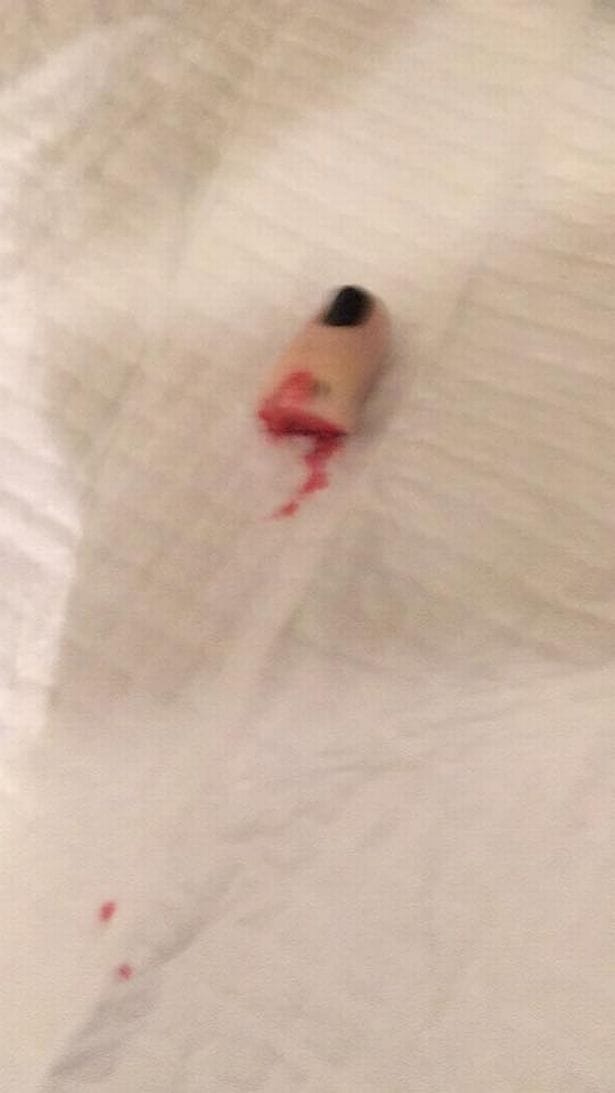 Woman claims to have cut off her little finger then bragged about it on Facebook