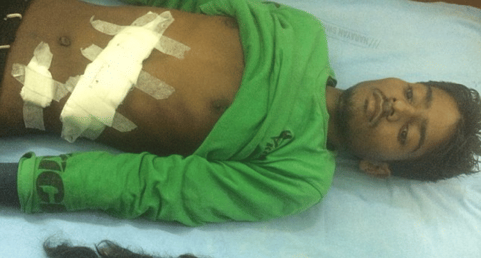 Teen Was Horrified To Find Parasite Twin With Teeth And Hair Inside His Stomach.