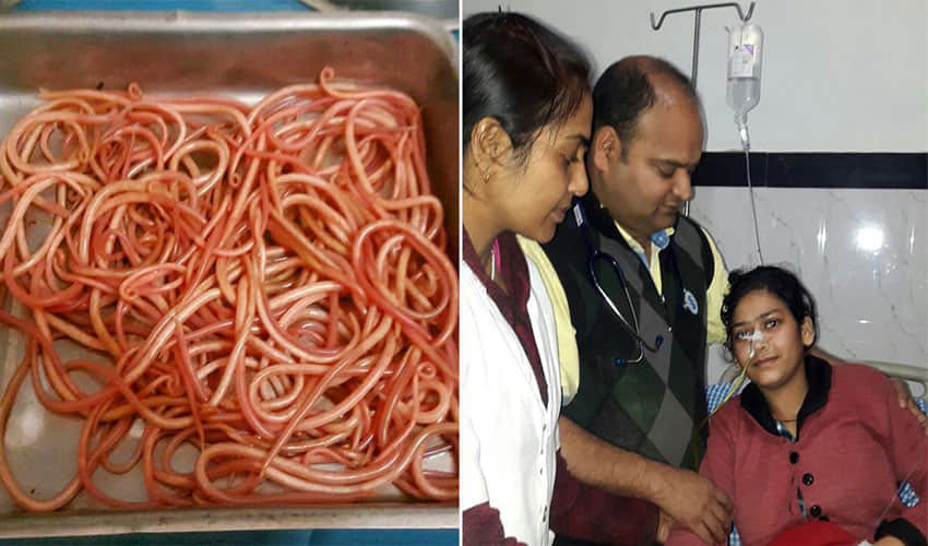 doctors found 150 earthworms in a woman stomach