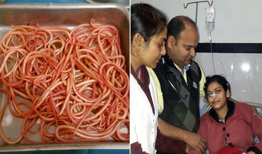 doctors found 150 earthworms in a woman stomach